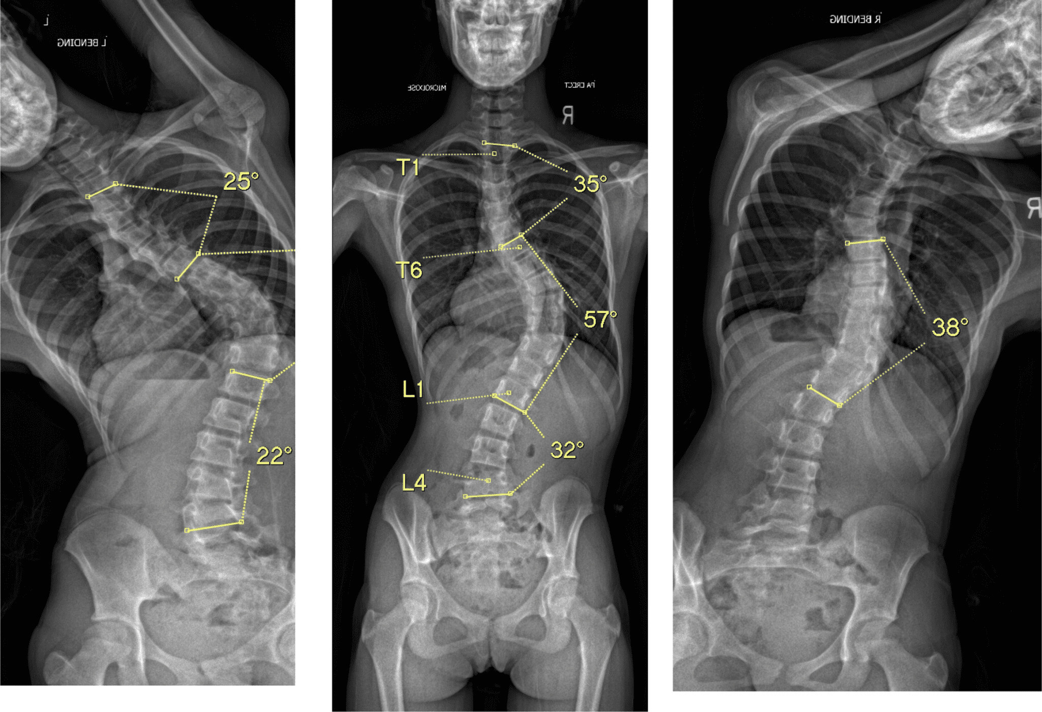 Scoliosis isn't Scary! - BP Chiro